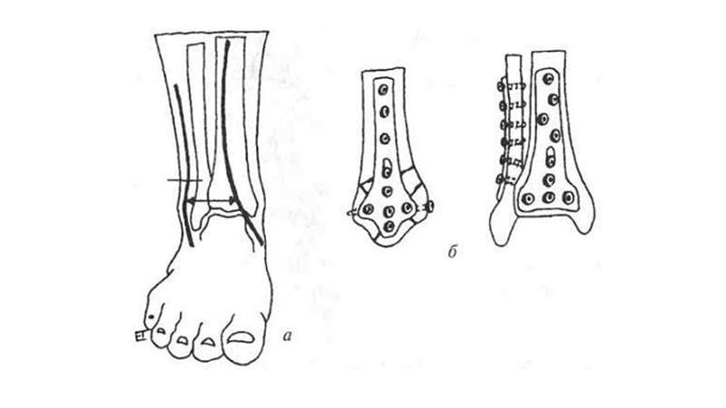 Трехлодыжечный перелом схема