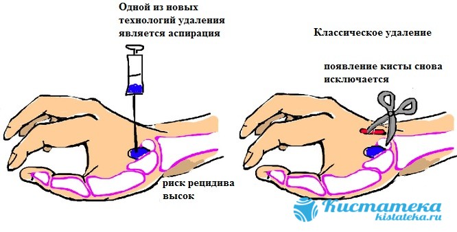 Удаление руки. Синовиальная киста лучезапястного сустава.