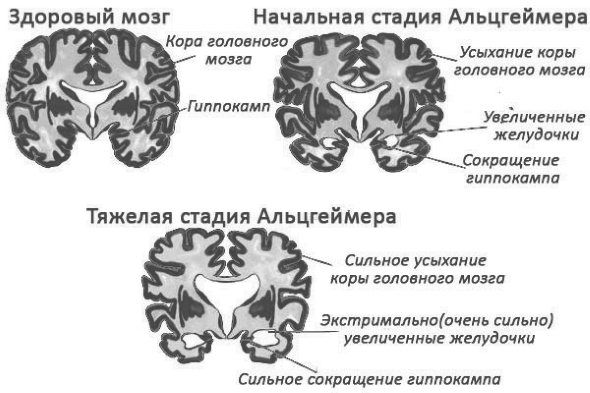 Последняя стадия деменции сколько. Фазы болезни Альцгеймера. Стадии Альцгеймера. Мозг при болезни Альцгеймера. Этапы болезни Альцгеймера.