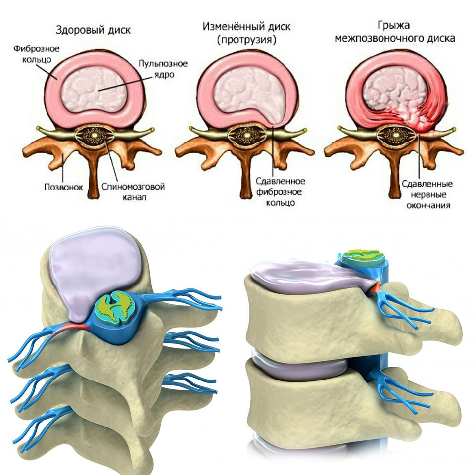 выбор матраса при грыже поясничного отдела позвоночника