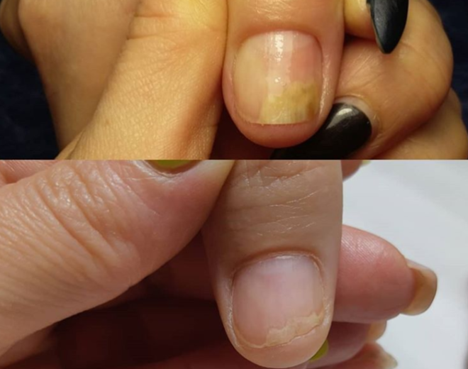 Ногти отслаиваются от ногтевого. Литеральный онихолизис. Травматичный онихолизис. Ногтевой онихолизис онихолизис пластины. Травматический онихолизис ногтей.