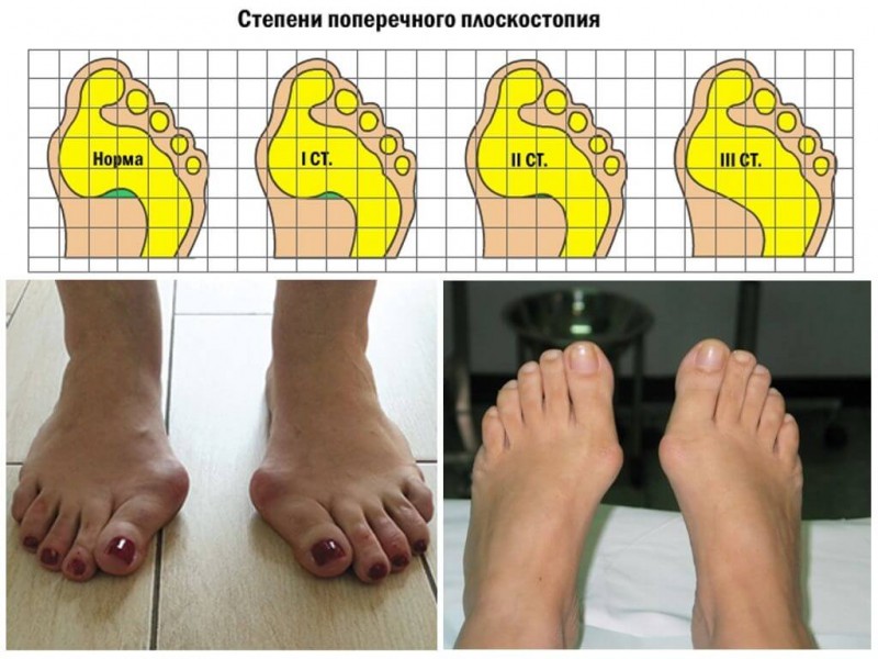 Картинки плоскостопие 3 степени