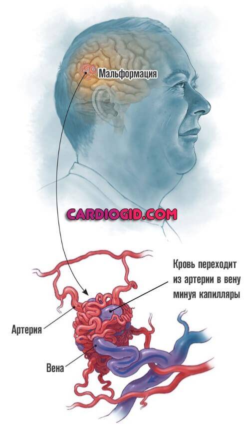 Сосудистые мальформации головного. Артериовенозная мальформация головного мозга. Мальформации сосудов головного мозга. Волформация головного мозга.