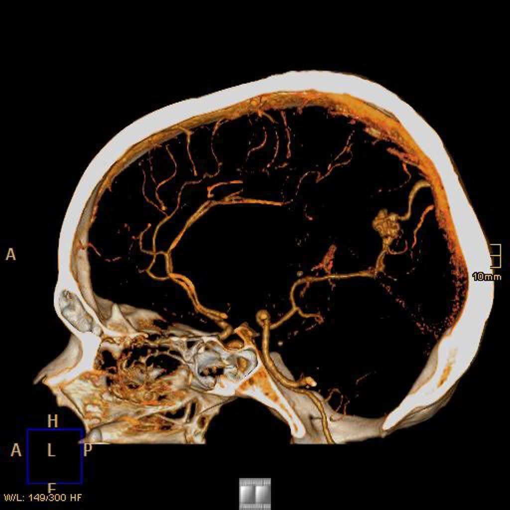 Сосудистые мальформации головного. Артериовенозная мальформация (АВМ). АВМ мальформация сосудов головного мозга. Артериовенозная мальформация сосудов головного мозга на кт. Артериовенозная мальформация головного мозга на кт.